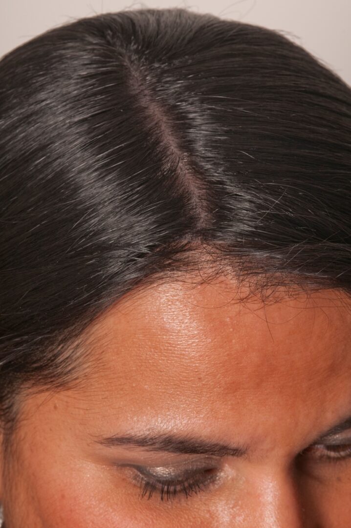 A Close Up View of the Scalp Line of a Woman